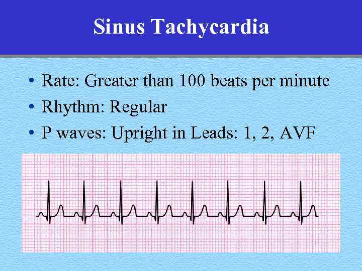 Sinus Tachycardia • Rate: Greater than 100 beats per minute • Rhythm: Regular •
