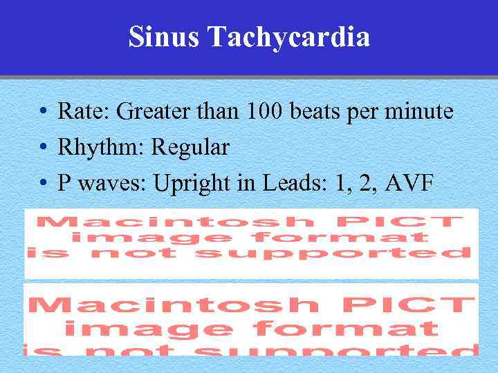 Sinus Tachycardia • Rate: Greater than 100 beats per minute • Rhythm: Regular •