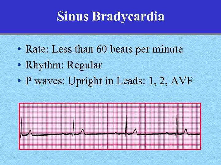 Sinus Bradycardia • Rate: Less than 60 beats per minute • Rhythm: Regular •