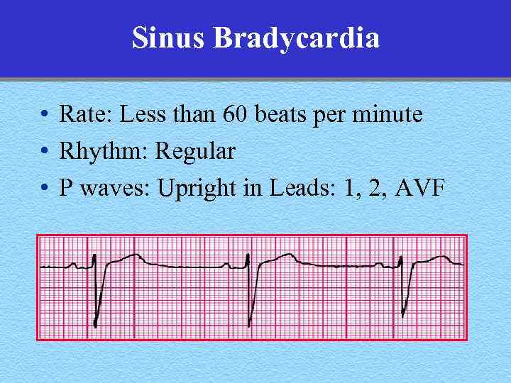 Sinus Bradycardia • Rate: Less than 60 beats per minute • Rhythm: Regular •