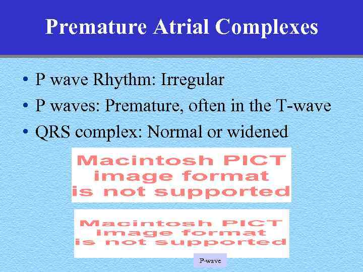 Premature Atrial Complexes • P wave Rhythm: Irregular • P waves: Premature, often in