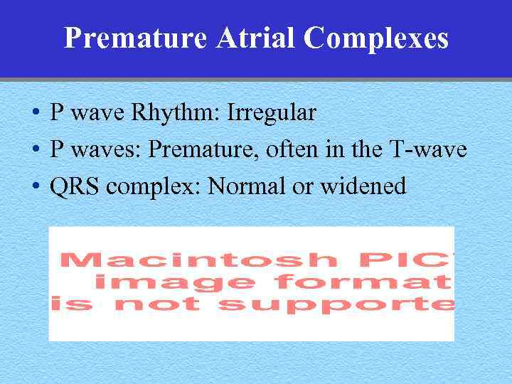 Premature Atrial Complexes • P wave Rhythm: Irregular • P waves: Premature, often in
