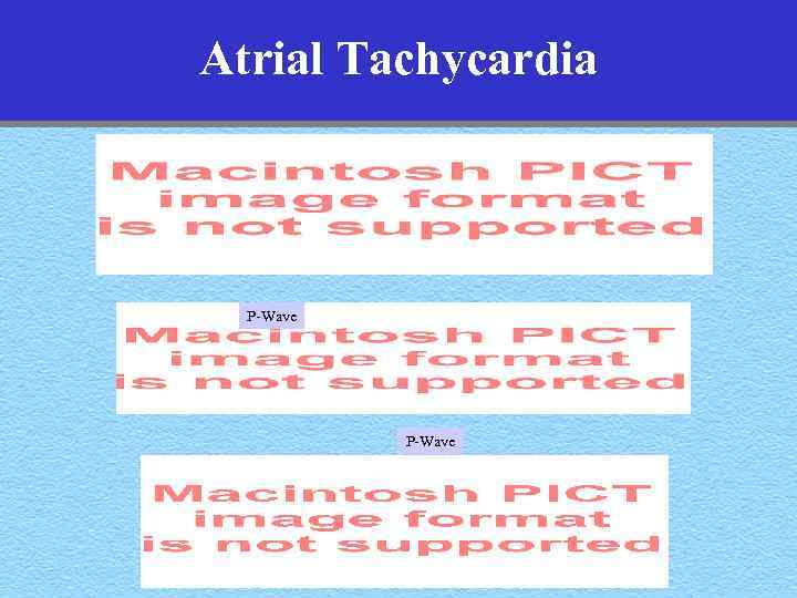 Atrial Tachycardia P-Wave 