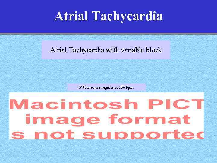 Atrial Tachycardia with variable block P-Waves are regular at 160 bpm 