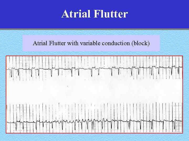 Atrial Flutter with variable conduction (block) 