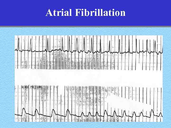 Atrial Fibrillation 