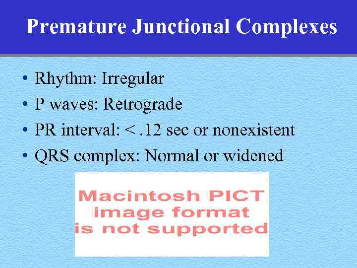 Premature Junctional Complexes • • Rhythm: Irregular P waves: Retrograde PR interval: <. 12