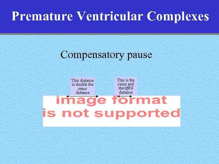 Premature Ventricular Complexes Compensatory pause This distance is double the sinus distance This is