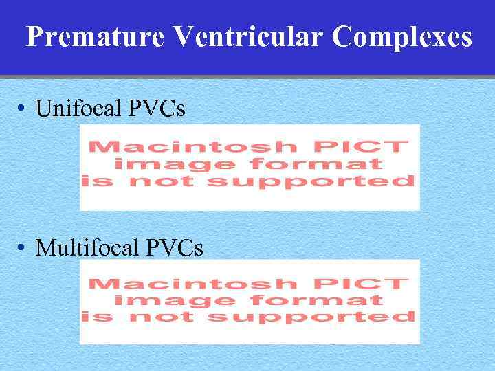 Premature Ventricular Complexes • Unifocal PVCs • Multifocal PVCs 