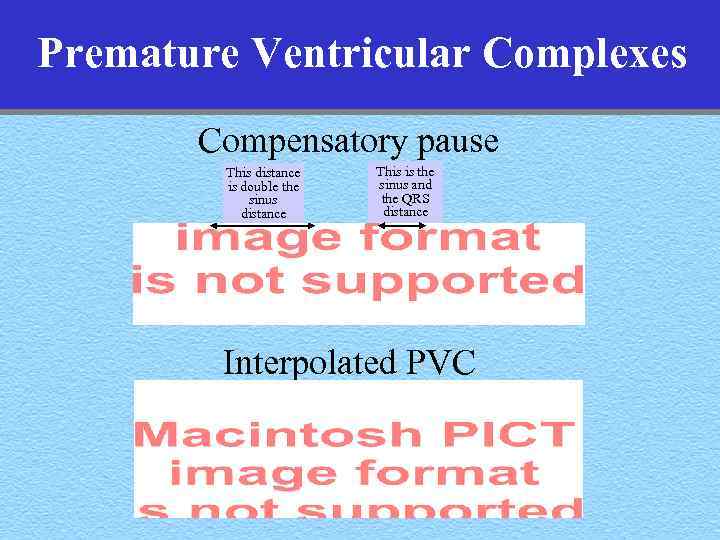 Premature Ventricular Complexes Compensatory pause This distance is double the sinus distance This is