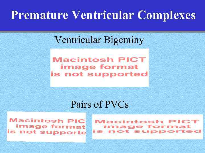 Premature Ventricular Complexes Ventricular Bigeminy Pairs of PVCs 