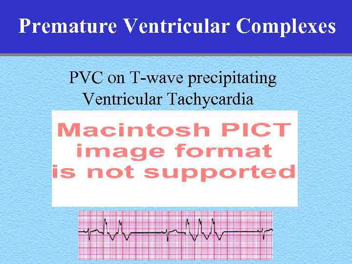 Premature Ventricular Complexes PVC on T-wave precipitating Ventricular Tachycardia 