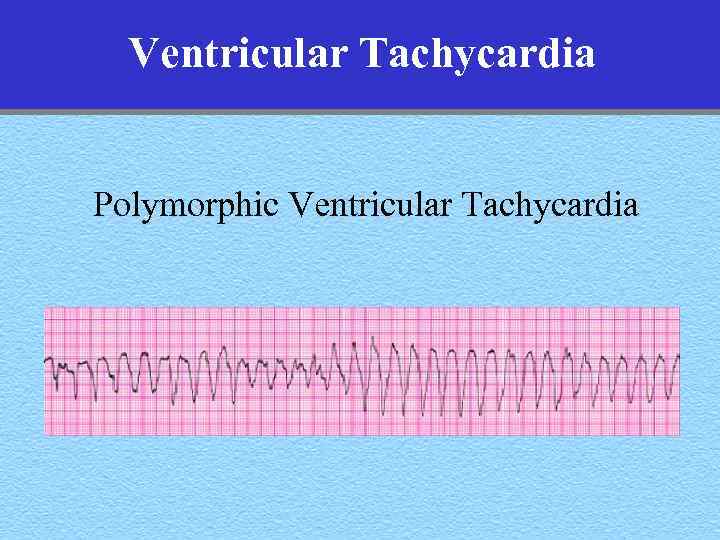 Ventricular Tachycardia Polymorphic Ventricular Tachycardia 