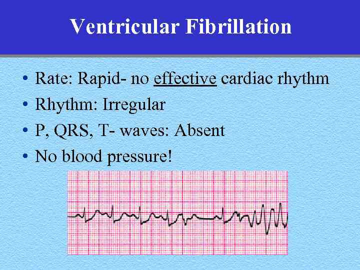 Ventricular Fibrillation • • Rate: Rapid- no effective cardiac rhythm Rhythm: Irregular P, QRS,