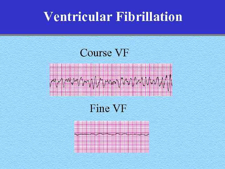 Ventricular Fibrillation Course VF Fine VF 