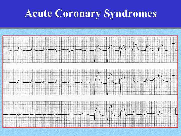 Acute Coronary Syndromes 