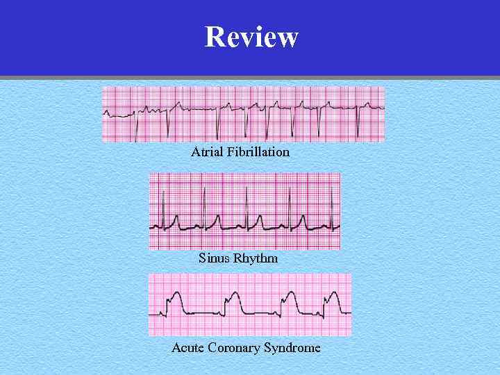 Review Atrial Fibrillation Sinus Rhythm Acute Coronary Syndrome 