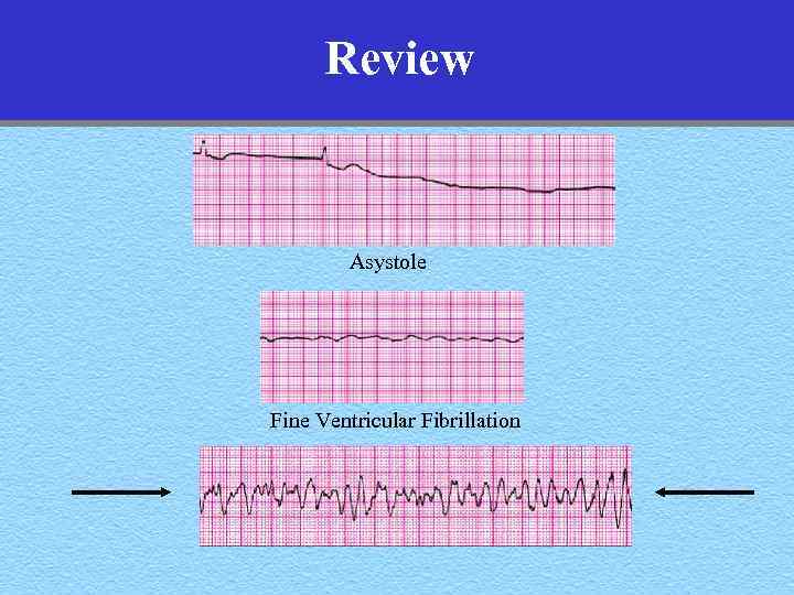 Review Asystole Fine Ventricular Fibrillation 