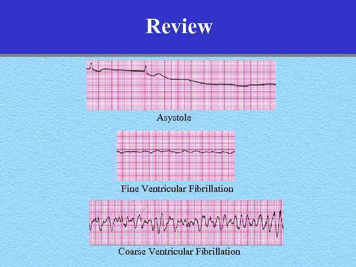 Review Asystole Fine Ventricular Fibrillation Coarse Ventricular Fibrillation 