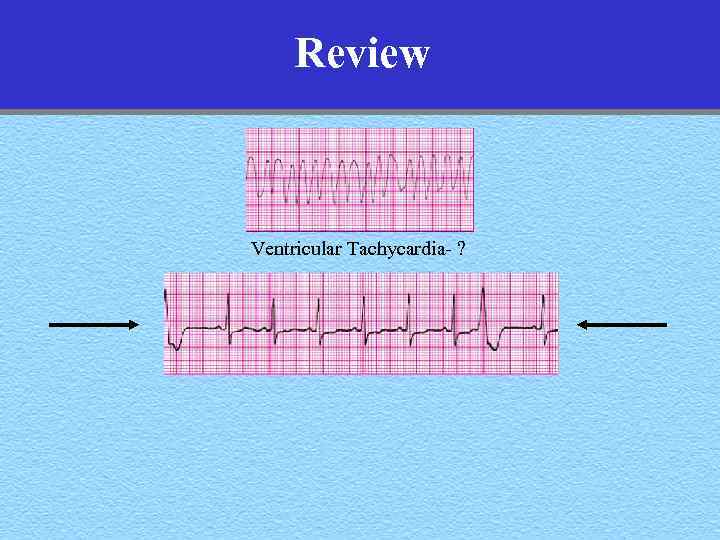 Review Ventricular Tachycardia- ? 