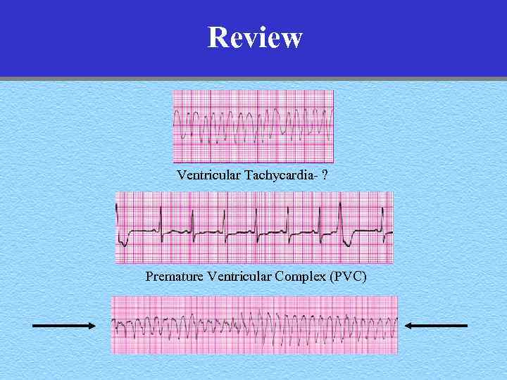 Review Ventricular Tachycardia- ? Premature Ventricular Complex (PVC) 