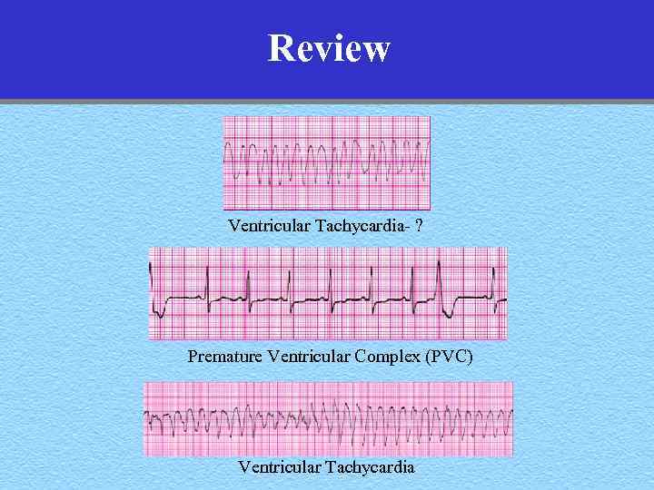 Review Ventricular Tachycardia- ? Premature Ventricular Complex (PVC) Ventricular Tachycardia 
