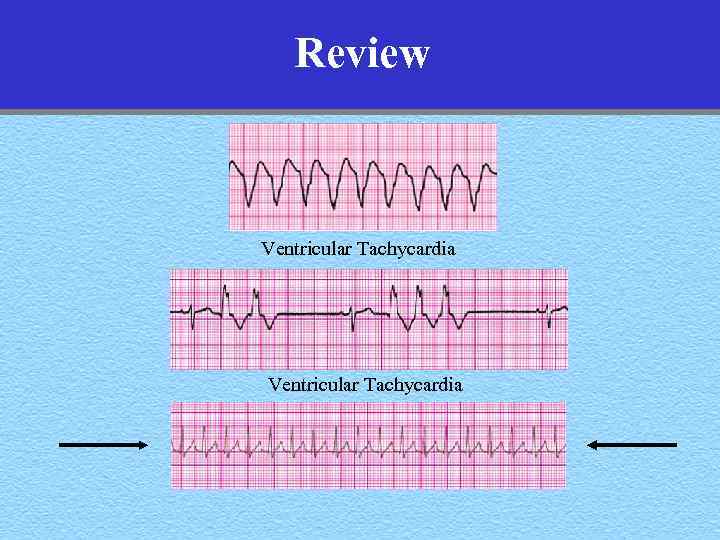 Review Ventricular Tachycardia 