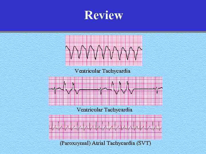 Review Ventricular Tachycardia (Paroxsymal) Atrial Tachycardia (SVT) 