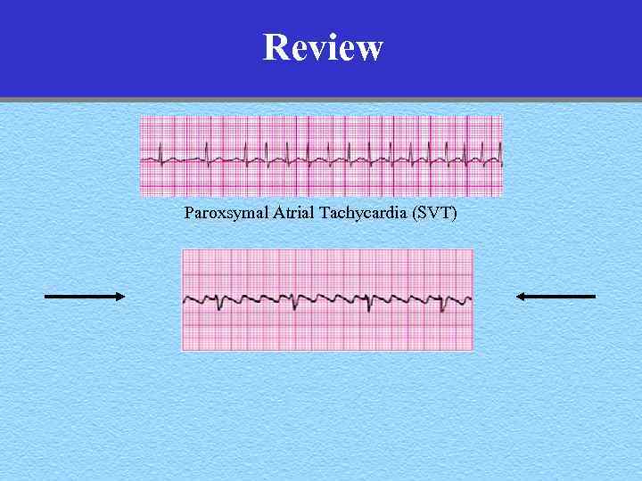 Review Paroxsymal Atrial Tachycardia (SVT) 