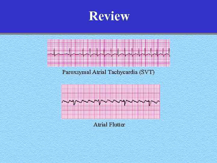 Review Paroxsymal Atrial Tachycardia (SVT) Atrial Flutter 