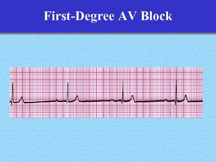 First-Degree AV Block 