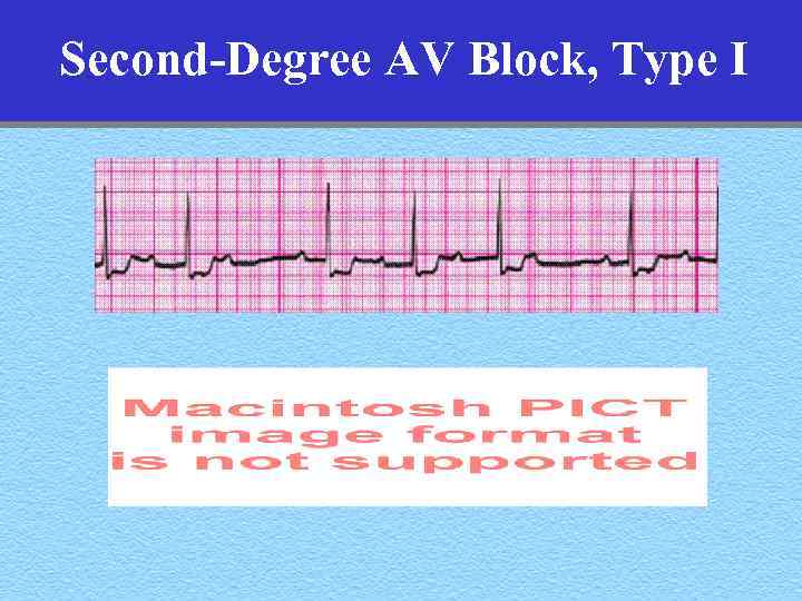 Second-Degree AV Block, Type I 