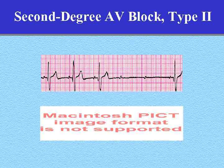 Second-Degree AV Block, Type II 