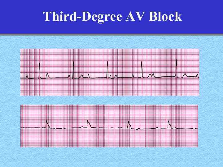 Third-Degree AV Block 