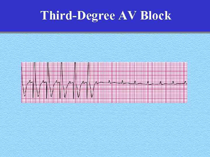 Third-Degree AV Block 