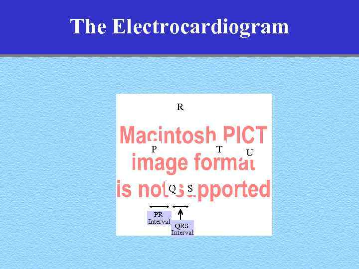 The Electrocardiogram R T P Q PR Interval S QRS Interval U 