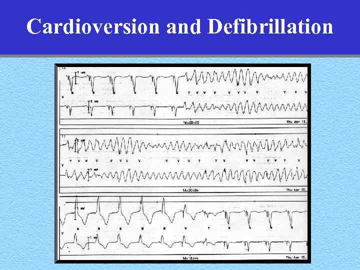 Cardioversion and Defibrillation 