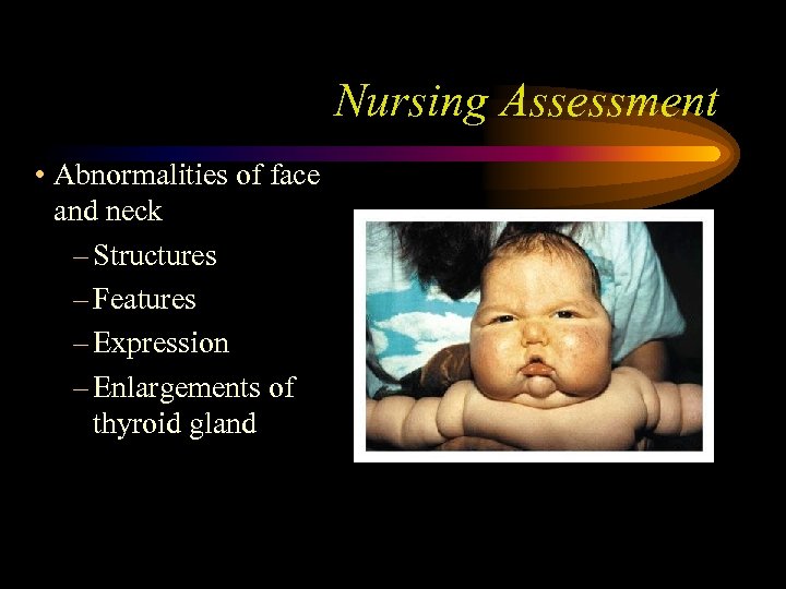 Nursing Assessment • Abnormalities of face and neck – Structures – Features – Expression