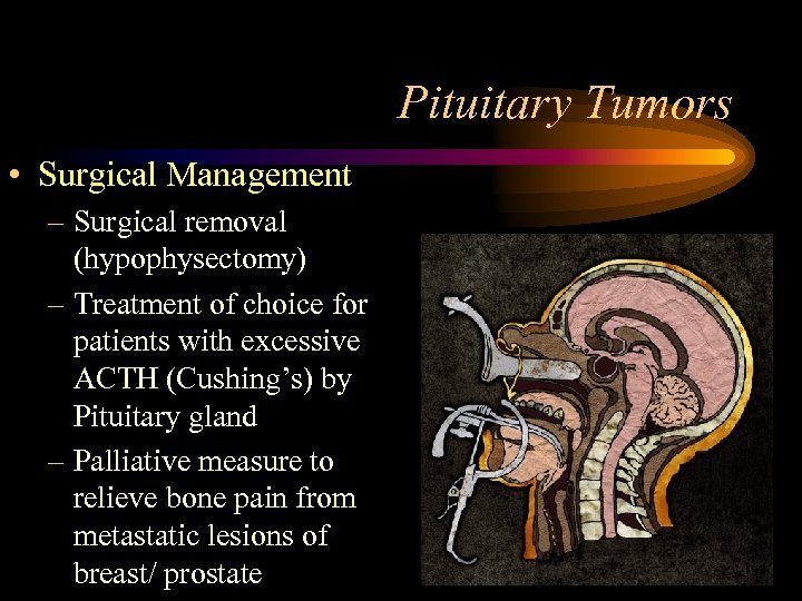 Pituitary Tumors • Surgical Management – Surgical removal (hypophysectomy) – Treatment of choice for