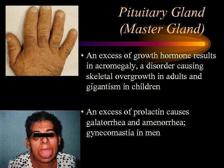 Pituitary Gland (Master Gland) • An excess of growth hormone results in acromegaly, a