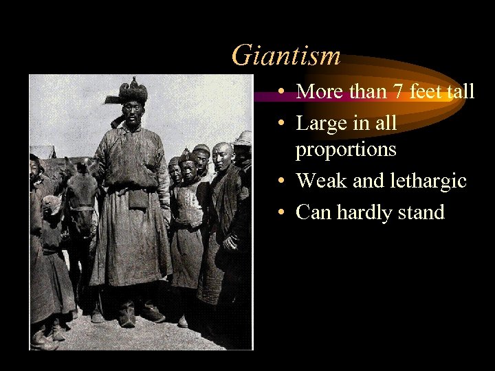 Giantism • More than 7 feet tall • Large in all proportions • Weak