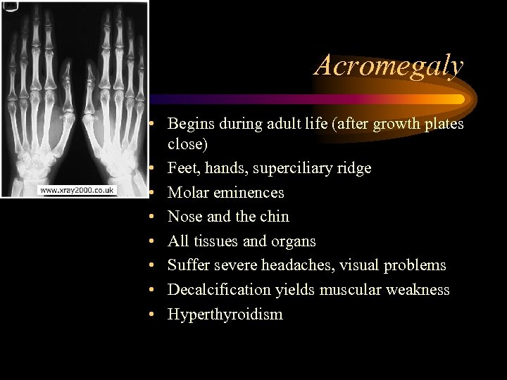 Acromegaly • Begins during adult life (after growth plates close) • Feet, hands, superciliary