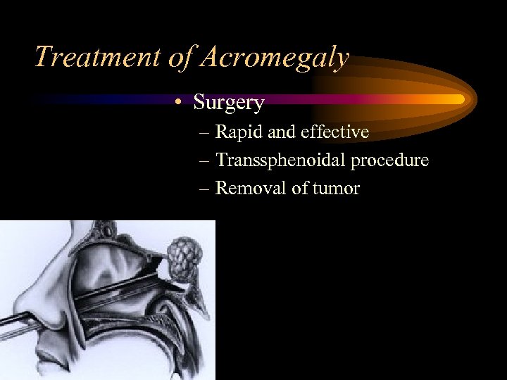 Treatment of Acromegaly • Surgery – Rapid and effective – Transsphenoidal procedure – Removal