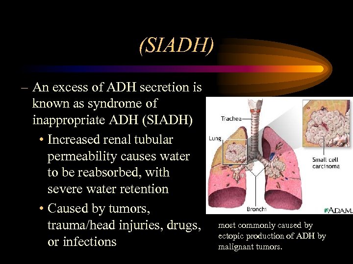 (SIADH) – An excess of ADH secretion is known as syndrome of inappropriate ADH