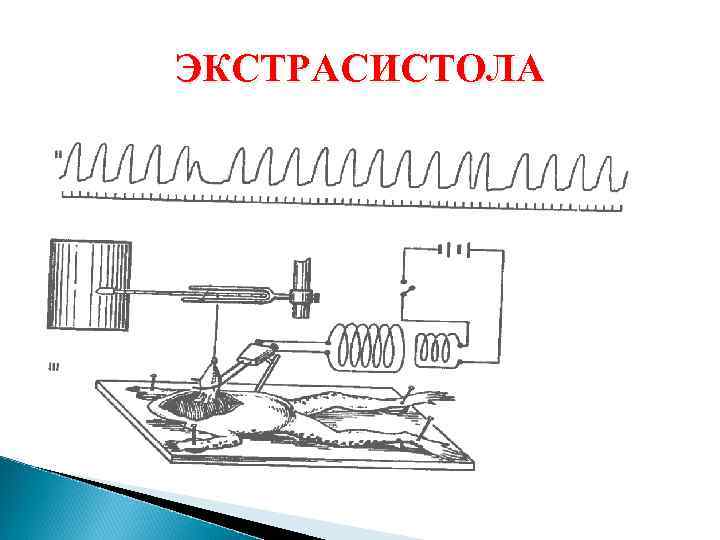 ЭКСТРАСИСТОЛА 