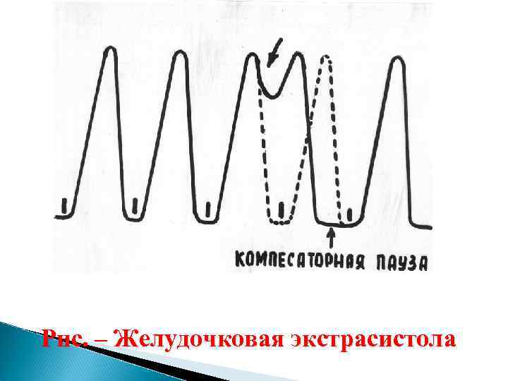 Рис. – Желудочковая экстрасистола 