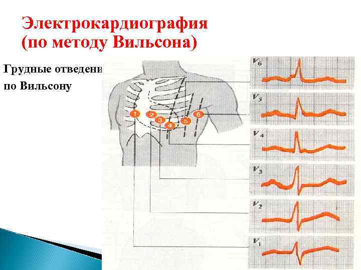 Регистрация экг. Грудные отведения по Вильсону. Грудные отведения ЭКГ Вильсона. Регистрация ЭКГ В грудных отведениях.