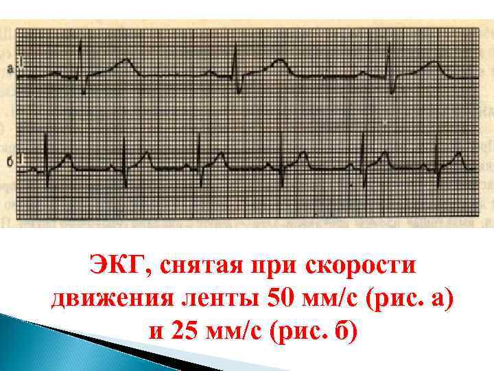 ЭКГ, снятая при скорости движения ленты 50 мм/с (рис. а) и 25 мм/с (рис.