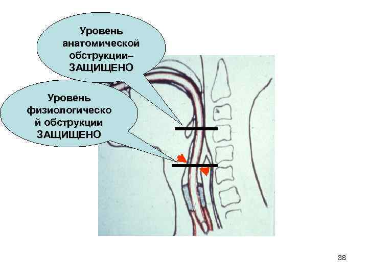 Уровень анатомической обструкции– ЗАЩИЩЕНО Уровень физиологическо й обструкции ЗАЩИЩЕНО 38 