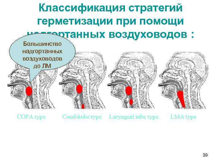 Классификация стратегий герметизации при помощи надгортанных воздуховодов : Большинство надгортанных воздуховодов до ЛМ COPA